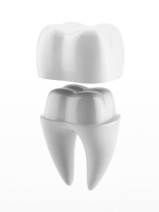 root canal Arlington TX