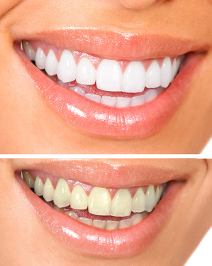 teeth whitening Grand Prairie