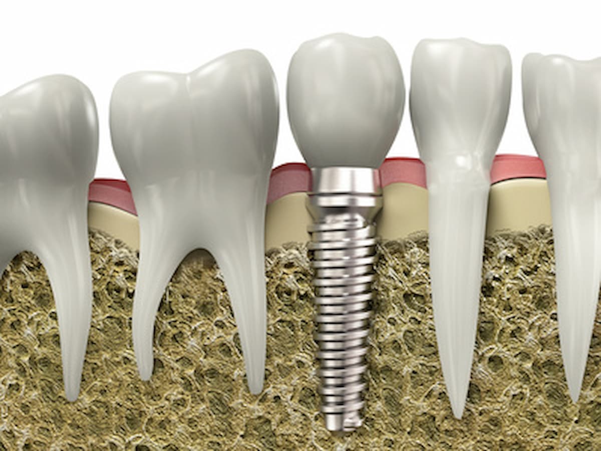dental implant 3d rendering