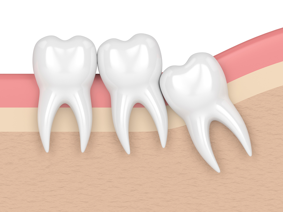 wisdom teeth Arlington TX
