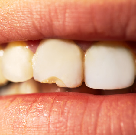  tooth extraction Grand Prairie