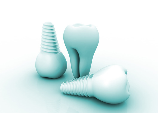 dental implants Arlington TX