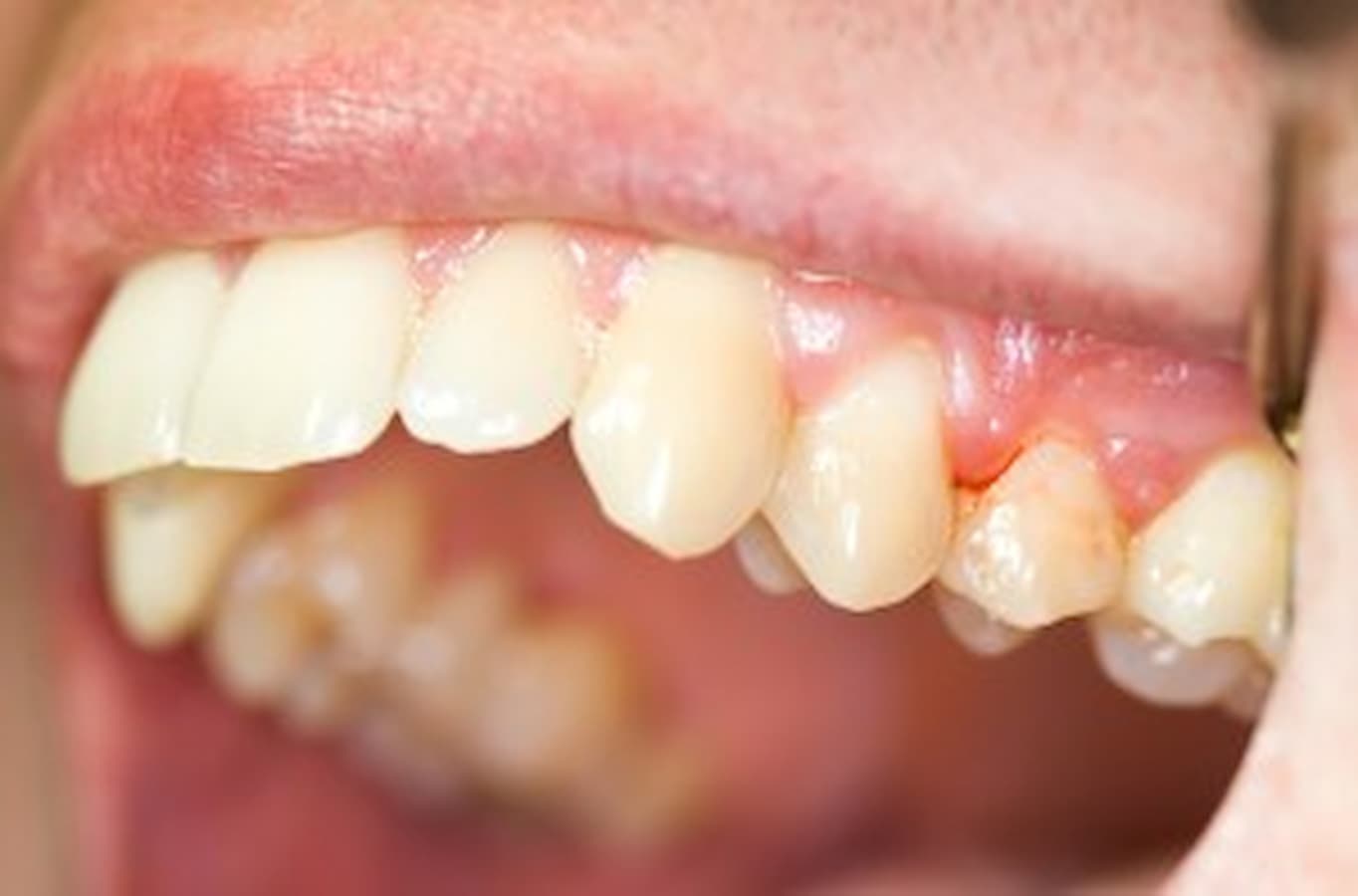 gum disease Grand Prairie